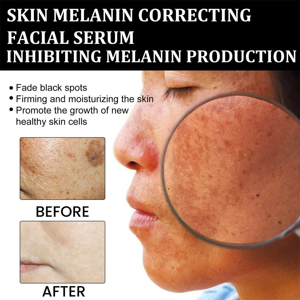Dobshow® Melanin Correcting Facial Serum with L-Ascorbic Acid- Erase Pigmentation in 2 weeks!