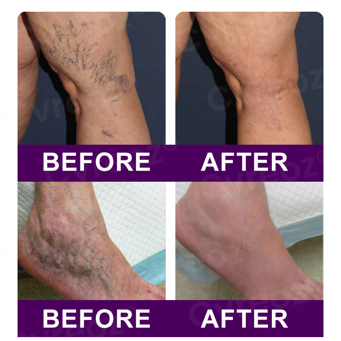 👩🏼‍⚕️Recommended by AHRQ🍀 Cvreoz® Polidocanol Nano Patches for Varicose Veins⭐️Stick It & Forget It