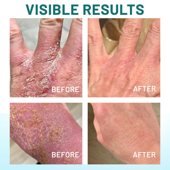 Dobshow® Probiotic + B 24-7 Moisture Eczema Relief Cream