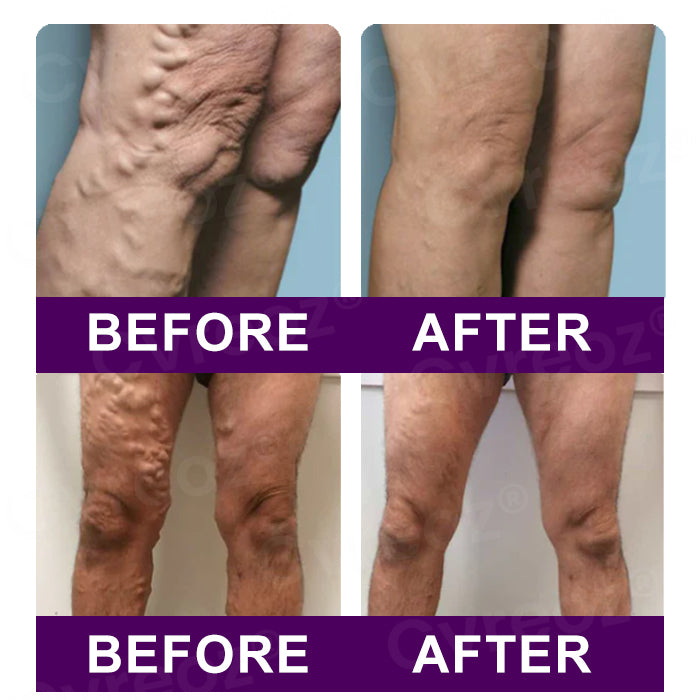 👩🏼‍⚕️Recommended by AHRQ🍀 Cvreoz® Polidocanol Nano Patches for Varicose Veins⭐️Stick It & Forget It