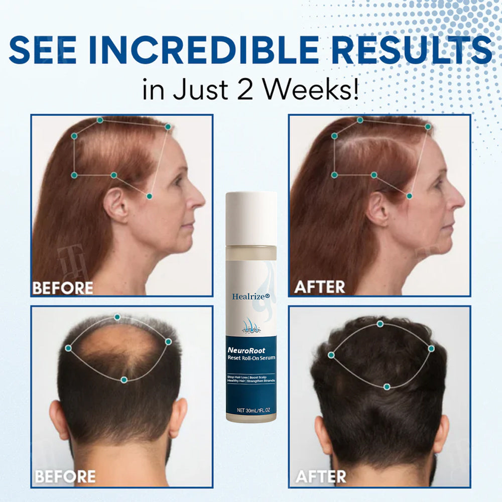 ✨𝙇𝙞𝙢𝙞𝙩𝙚𝙙-𝙏𝙞𝙢𝙚 𝙊𝙛𝙛𝙚𝙧   | Healrize®  NeuroRoot Reset Roll-On Serum