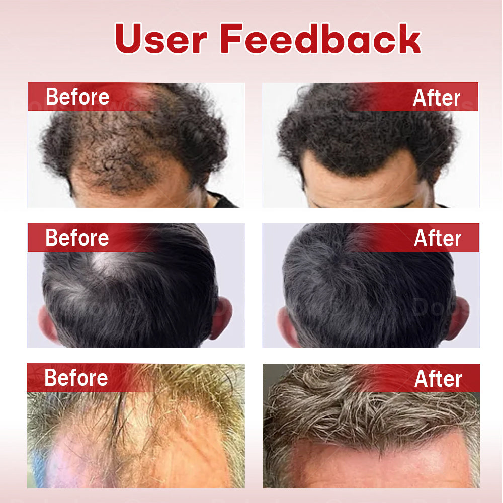 Cvreoz® Hair Regrowth System