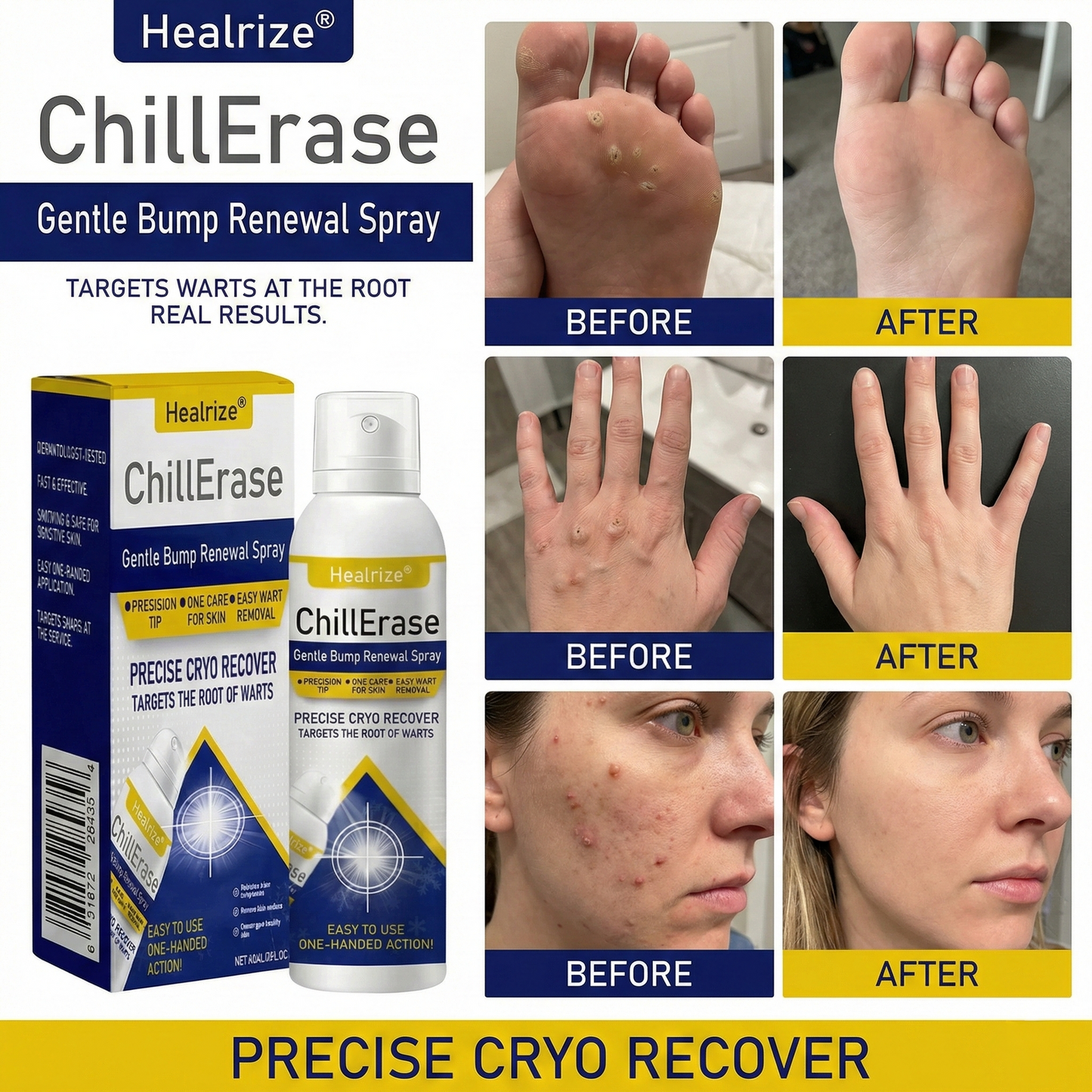 ❄️Healrize®ChillErase Gentle Bump Renewal Spray