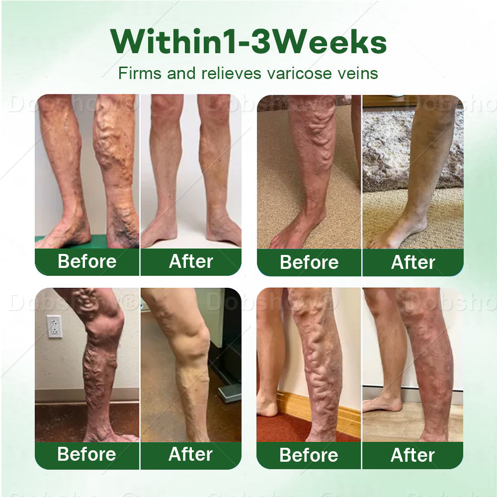 🎅 𝘾𝙝𝙧𝙞𝙨𝙩𝙢𝙖𝙨 𝙎𝙖𝙡𝙚 | Croaie® VeinLock Microneedle Patch