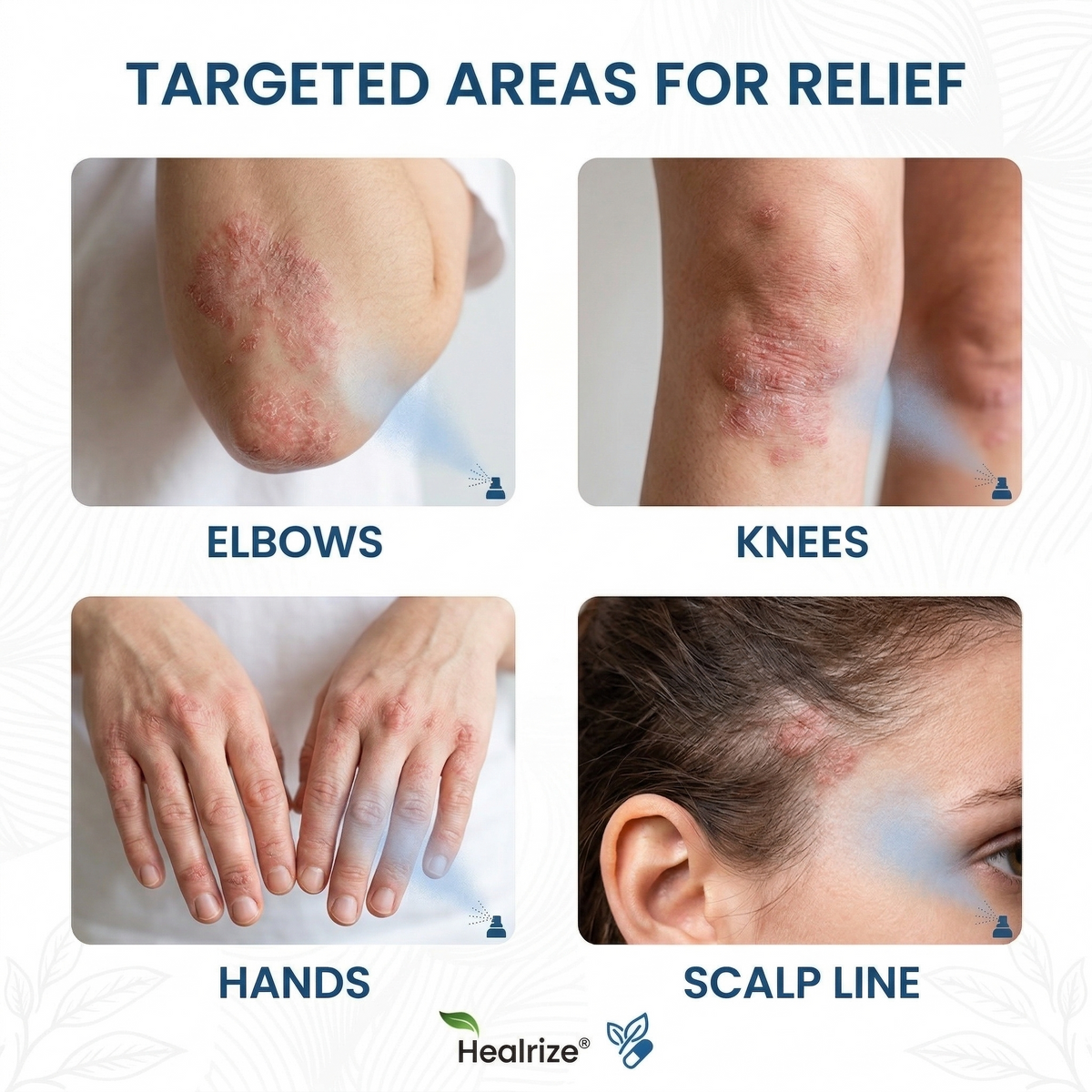 🔥Healrize® Magnesium Botanical Spray – Advanced Skin Recovery for Psoriasis & Eczema | Rapid Soothing, Steroid-Free