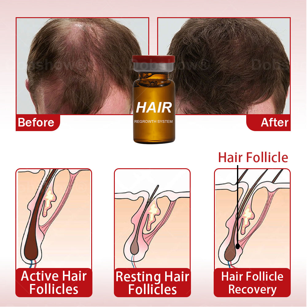 Cvreoz® Hair Regrowth System