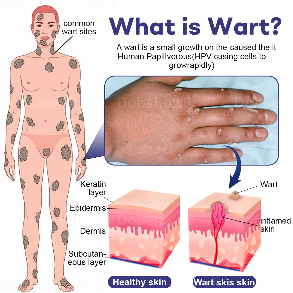 Cvreoz®  Wart Eraser Pro