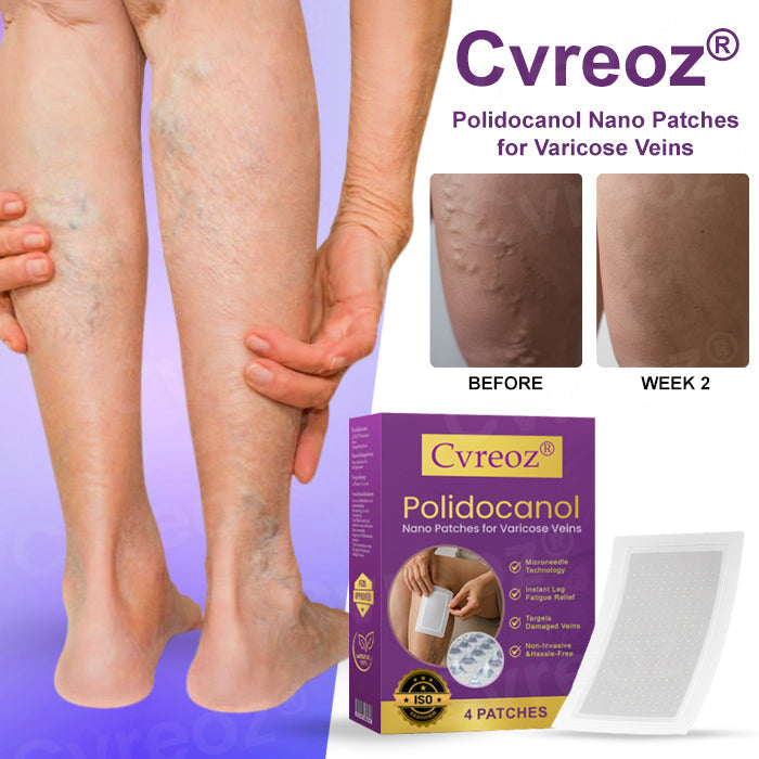 👩🏼‍⚕️Recommended by AHRQ🍀 Cvreoz® Polidocanol Nano Patches for Varicose Veins⭐️Stick It & Forget It