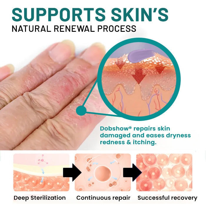Dobshow® Probiotic + B 24-7 Moisture Eczema Relief Cream