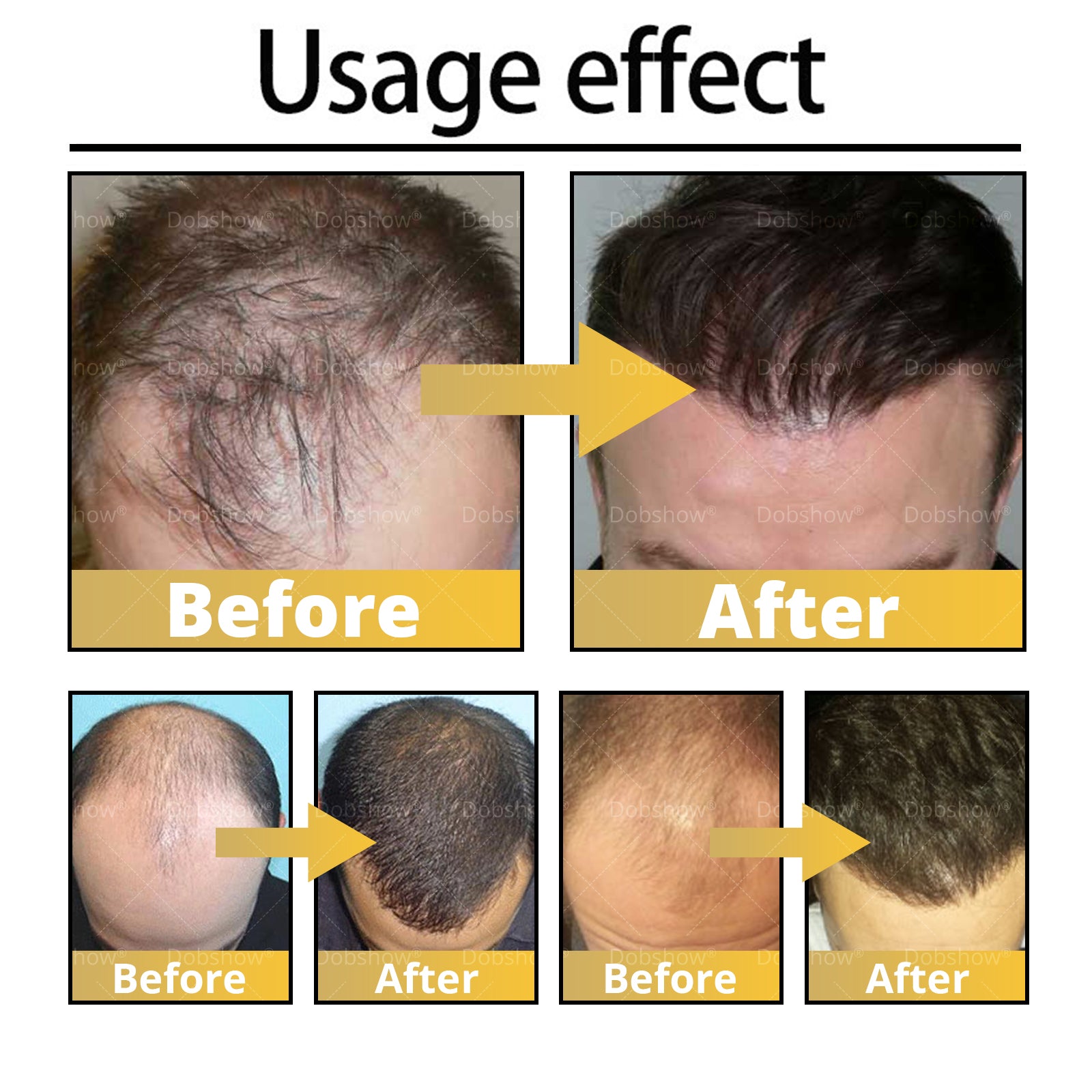 ⓒⓥⓡⓔⓞⓩ® 5% Minoxidil Hair Pro-growth Treatment